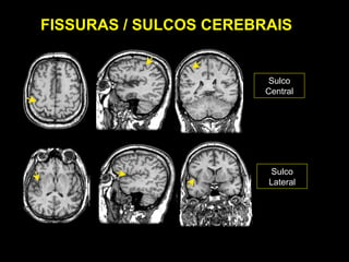 FISSURAS / SULCOS CEREBRAIS


                         Sulco
                        Central




                        Sulco
                        Lateral
 