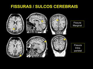 FISSURAS / SULCOS CEREBRAIS


                         Fissura
                         Marginal




                          Fissura
                           Intra-
                          parietal
 