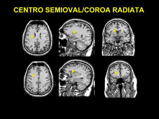CENTRO SEMIOVAL/COROA RADIATA
 