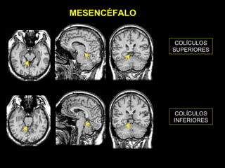 MESENCÉFALO


               COLÍCULOS
              SUPERIORES




               COLÍCULOS
              INFERIORES
 