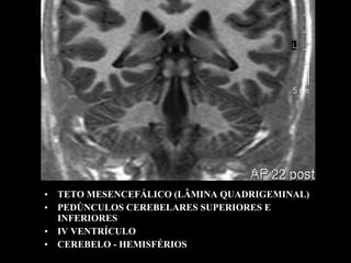 • TETO MESENCEFÁLICO (LÂMINA QUADRIGEMINAL)
• PEDÚNCULOS CEREBELARES SUPERIORES E
  INFERIORES
• IV VENTRÍCULO
• CEREBELO - HEMISFÉRIOS
 