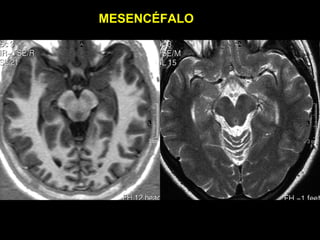 MESENCÉFALO
 