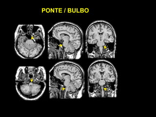 PONTE / BULBO
 