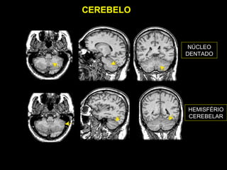 CEREBELO



            NÚCLEO
           DENTADO




           HEMISFÉRIO
           CEREBELAR
 