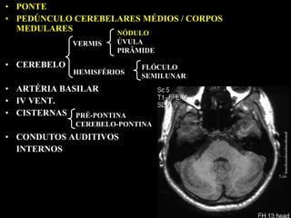 • PONTE
• PEDÚNCULO CEREBELARES MÉDIOS / CORPOS
  MEDULARES        NÓDULO
             VERMIS   ÚVULA
                      PIRÂMIDE

• CEREBELO                 FLÓCULO
             HEMISFÉRIOS
                           SEMILUNAR
• ARTÉRIA BASILAR
• IV VENT.
• CISTERNAS PRÉ-PONTINA
             CEREBELO-PONTINA
• CONDUTOS AUDITIVOS
  INTERNOS
 