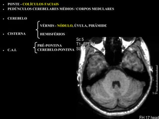 • PONTE - COLÍCULOS FACIAIS
• PEDÚNCULOS CEREBELARES MÉDIOS / CORPOS MEDULARES

• CEREBELO
                VÉRMIS - NÓDULO, ÚVULA, PIRÂMIDE

• CISTERNA      HEMISFÉRIOS


               PRÉ-PONTINA
• C.A.I.       CEREBELO-PONTINA
 