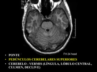 • PONTE
• PEDÚNCULOS CEREBELARES SUPERIORES
• CEREBELO - VERMIS (LÍNGULA, LÓBULO CENTRAL,
  CULMEN, DECLIVE)
 