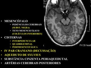 • MESENCÉFALO
      • PEDÚNCULOS CEREBRAIS
        (SUBST. NIGRA)
      • TETO MESENCEFÁLICO
        (COLÍCULOS INFERIORES)
• CISTERNAS
      • INTERPEDUNCULAR
      • QUADRIGEMINAL
      • PERIMESENCEFÁLICA
•   IV PAR CRANIANO (DECUSSAÇÃO)
•   AQUEDUTO DE SYLVIUS
•   SUBSTÂNCIA CINZENTA PERIAQUEDUTAL
•   ARTÉRIAS CEREBRAIS POSTERIORES
 