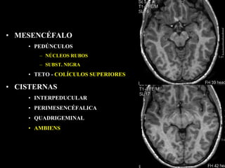 • MESENCÉFALO
    • PEDÚNCULOS
       – NÚCLEOS RUBOS
       – SUBST. NIGRA

    • TETO - COLÍCULOS SUPERIORES

• CISTERNAS
    • INTERPEDUCULAR
    • PERIMESENCÉFALICA
    • QUADRIGEMINAL
    • AMBIENS
 