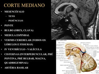 CORTE MEDIANO
• MESENCÉFALO
  – TETO
  – PEDÚNCULO

• PONTE
• BULBO (OBEX, CLAVA)
• MEDULA ESPINHAL
• VERMIS CEREBELAR (TODOS OS
  LÓBULOS E FISSURAS)
• IV VENTRÍCULO - VALÉCULA
• CISTERNAS (INTERPEDUNCULAR, PRÉ
  PONTINA, PRÉ BULBAR, MAGNA,
  QUADRIGEMINAL)
• ARTÉRIA BASILAR
 