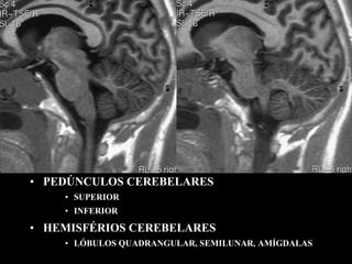 • PEDÚNCULOS CEREBELARES
    • SUPERIOR
    • INFERIOR

• HEMISFÉRIOS CEREBELARES
    • LÓBULOS QUADRANGULAR, SEMILUNAR, AMÍGDALAS
 