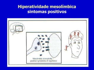 Hiperatividade mesolímbica
sintomas positivos
 