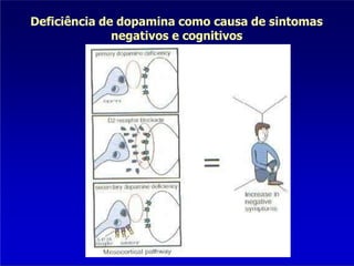 Deficiência de dopamina como causa de sintomas
negativos e cognitivos
 
