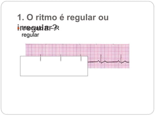 1. O ritmo é regular ou
irregular? Intervalo R – R
regular
 