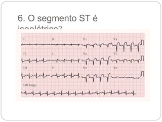 6. O segmento ST é
isoelétrico?
 