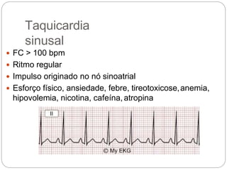 Taquicardia
sinusal
 FC > 100 bpm
 Ritmo regular
 Impulso originado no nó sinoatrial
 Esforço físico, ansiedade, febre, tireotoxicose,anemia,
hipovolemia, nicotina, cafeína,atropina
 