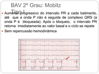 BAV 2º Grau: Mobitz
Tipo I Aumento progressivo do intervalo PR a cada batimento,
até que a onda P não é seguida de complexo QRS (a
onda P é bloqueada). Após o bloqueio, o intervalo PR
retorna imediatamente ao valor basal e o ciclo se repete
 Sem repercussão hemodinâmica
 