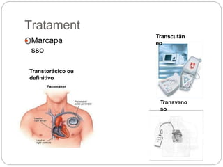 Tratament
o Marcapa
sso
Transtorácico ou
definitivo
Transcutân
eo
Transveno
so
 