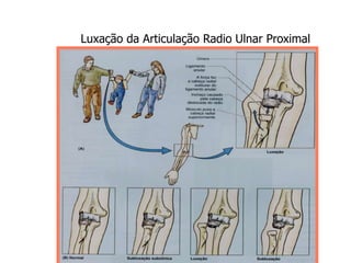 Luxação da Articulação Radio Ulnar Proximal
 