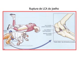 Ruptura de LCA do joelho
 