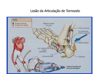 Lesão da Articulação de Tornozelo
 