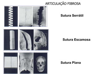 ARTICULAÇÃO FIBROSA
Sutura Serrátil
Sutura Escamosa
Sutura Plana
 