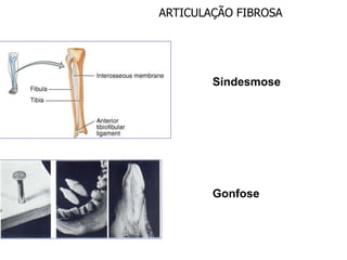 ARTICULAÇÃO FIBROSA
Sindesmose
Gonfose
 