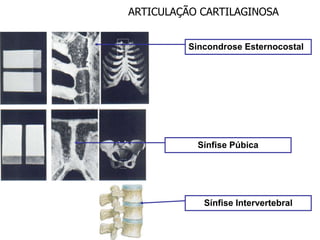 ARTICULAÇÃO CARTILAGINOSA
Sincondrose Esternocostal
Sínfise Púbica
Sínfise Intervertebral
 
