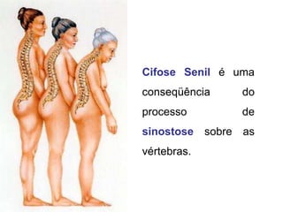 Cifose Senil é uma
conseqüência do
processo de
sinostose sobre as
vértebras.
 
