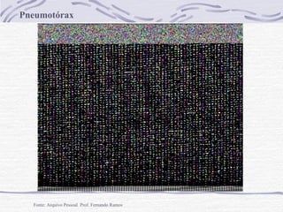 Pneumotórax

Fonte: Arquivo Pessoal Prof. Fernando Ramos

 