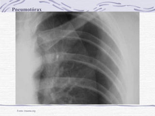 Pneumotórax

Fonte: trauma.org

 