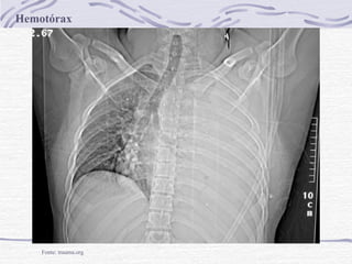 Hemotórax

Fonte: trauma.org

 