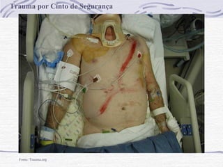 Trauma por Cinto de Segurança

Fonte: Trauma.org

 