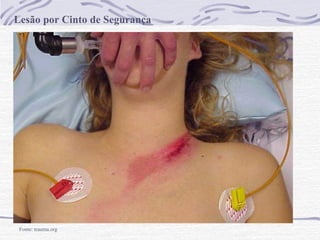 Lesão por Cinto de Segurança

Fonte: trauma.org

 