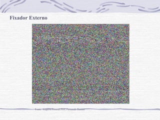 Fixador Externo

Fonte: Arquivo Pessoal Prof. Fernando Ramos

 