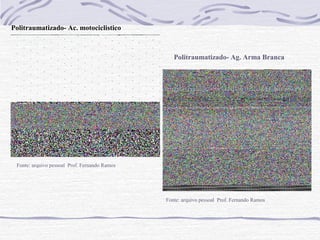 Politraumatizado- Ac. motociclistico

Politraumatizado- Ag. Arma Branca

Fonte: arquivo pessoal Prof. Fernando Ramos

Fonte: arquivo pessoal Prof. Fernando Ramos

 
