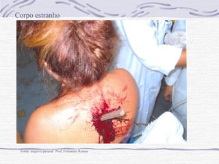 Corpo estranho

Fonte: arquivo pessoal Prof. Fernando Ramos

 