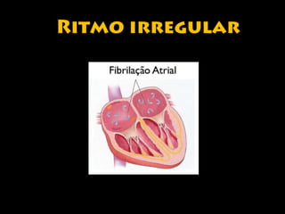 Ritmo irregular 
 