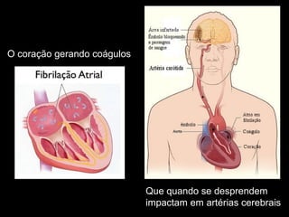 O coração gerando coágulos 
Que quando se desprendem 
impactam em artérias cerebrais 
 