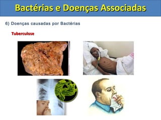 6) Doenças causadas por Bactérias
TuberculoseTuberculose
Bactérias e Doenças AssociadasBactérias e Doenças Associadas
 
