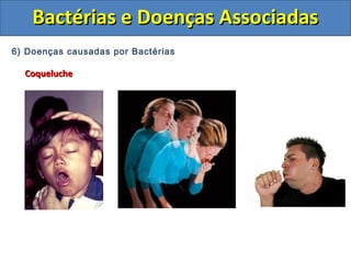 6) Doenças causadas por Bactérias
CoquelucheCoqueluche
Bactérias e Doenças AssociadasBactérias e Doenças Associadas
 