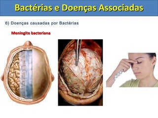 6) Doenças causadas por Bactérias
Meningite bacterianaMeningite bacteriana
Bactérias e Doenças AssociadasBactérias e Doenças Associadas
 