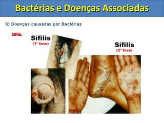 6) Doenças causadas por Bactérias
SífilisSífilis
Bactérias e Doenças AssociadasBactérias e Doenças Associadas
 