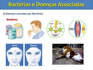 6) Doenças causadas por Bactérias
Botulismo
Botulismo
Bactérias e Doenças Associadas
Bactérias e Doenças Associadas
 