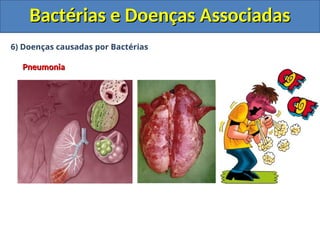 6) Doenças causadas por Bactérias
Pneumonia
Pneumonia
Bactérias e Doenças Associadas
Bactérias e Doenças Associadas
 