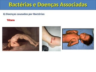 6) Doenças causadas por Bactérias
Tétano
Tétano
Bactérias e Doenças Associadas
Bactérias e Doenças Associadas
 