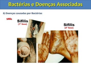6) Doenças causadas por Bactérias
Sífilis
Sífilis
Bactérias e Doenças Associadas
Bactérias e Doenças Associadas
 
