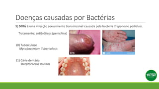 Doenças causadas por Bactérias
9) Sífilis é uma infecção sexualmente transmissível causada pela bactéria Treponema pallidum.
Tratamento: antibióticos (penicilina)
10) Tuberculose
Mycobacterium Tuberculosis
11) Cárie dentária
Streptococcus mutans
 