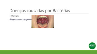 Doenças causadas por Bactérias
17)Faringite
Streptococcus pyogenes
 
