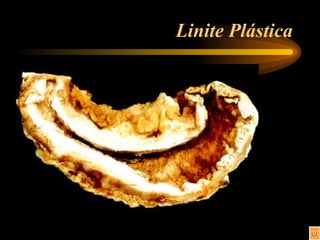 Linite Plástica 